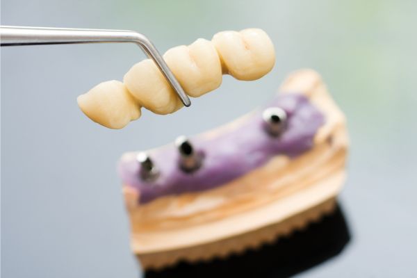 dental implant bridge model